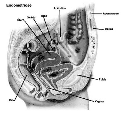 Endometriose